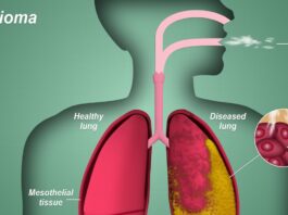 Mesothelioma Symptoms