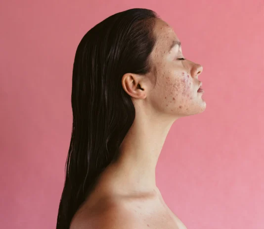 Women Can Tackle Hormonal Acne