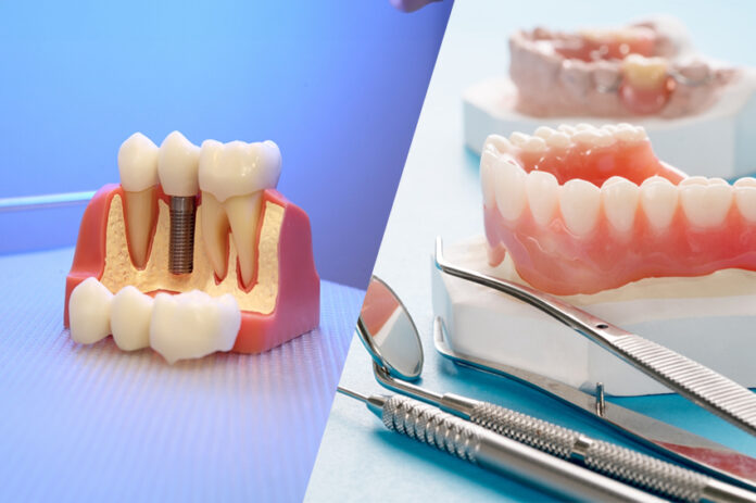 Choosing between dental implants and dentures