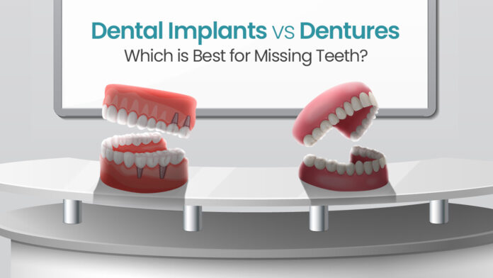 Dental Implants vs. Dentures: A Comparison