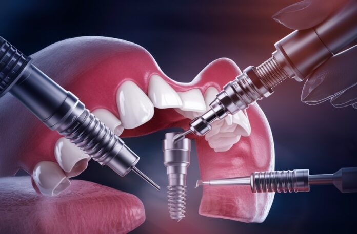 What are Dental Implants