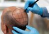 hair transplantation