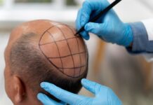 hair transplantation