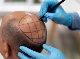 hair transplantation