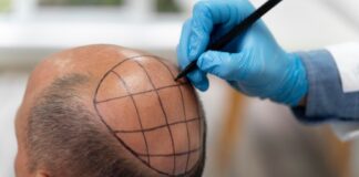 hair transplantation