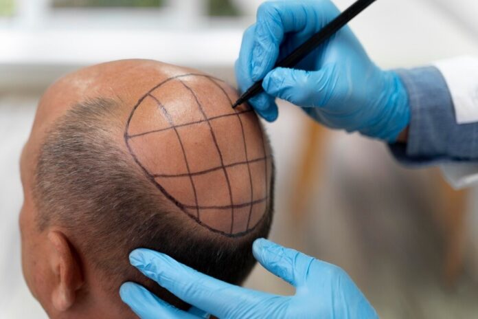 hair transplantation